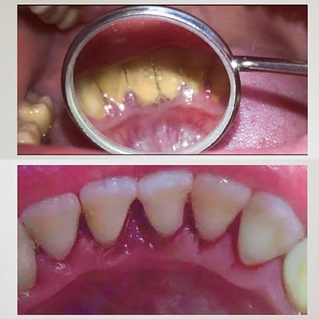 Remoção de tártaro e limpeza — antes e depois
